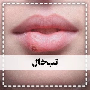 عکس تب‌خال