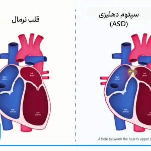 عکس ASDچیست؟